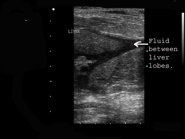 Liver ultrasound