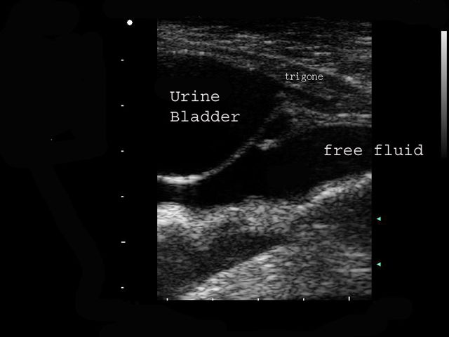 bladder ultrasound
