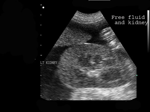 Kidney anf ascites ultrasound