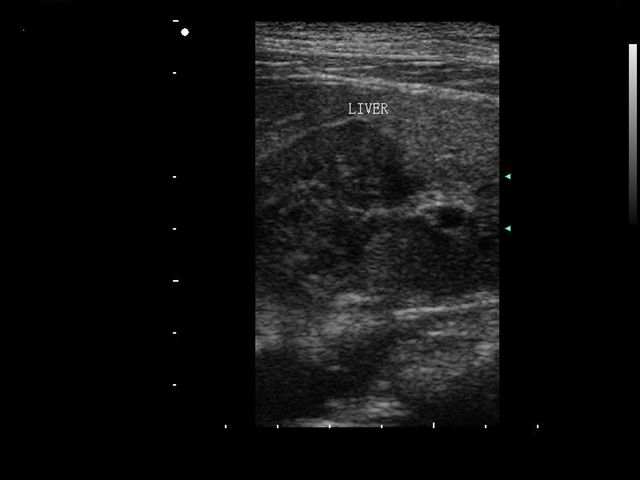 liver mass ultrasound