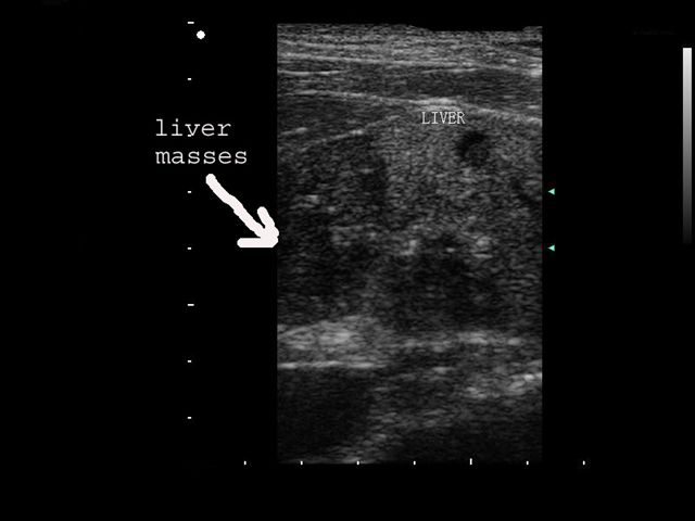 liver mass ultrasound 