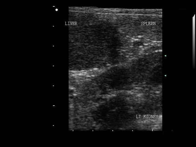 liver kidney spleen ultrasound