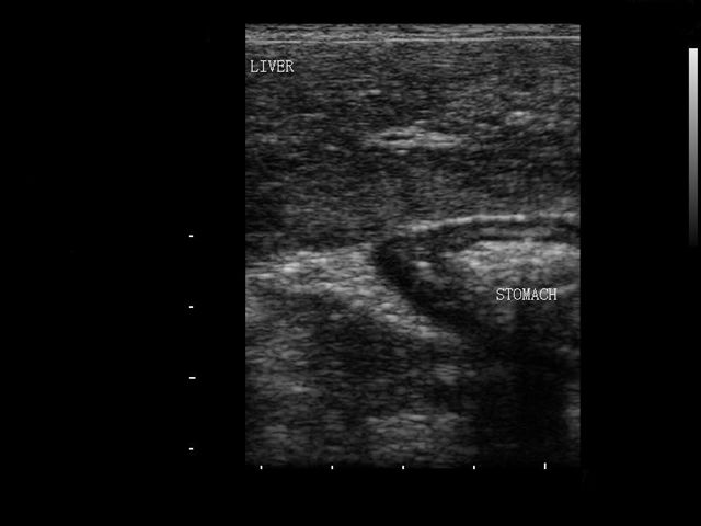liver and stomach ultrasound
