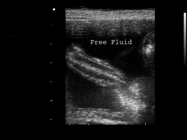 ascites and small intestine ultrsound