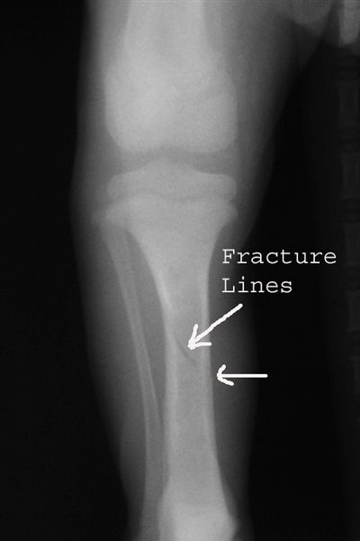 fractured tibia canine radiograph