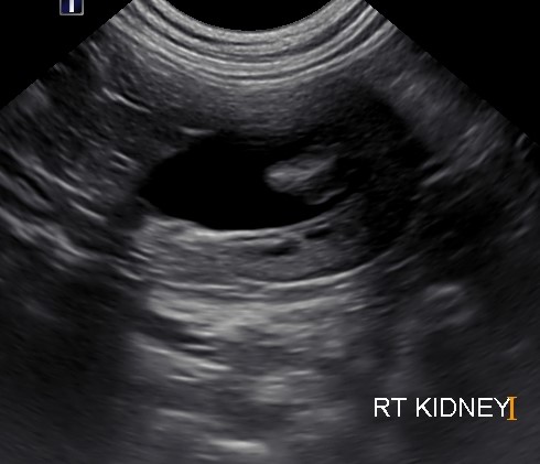Distended pelvis Kidney