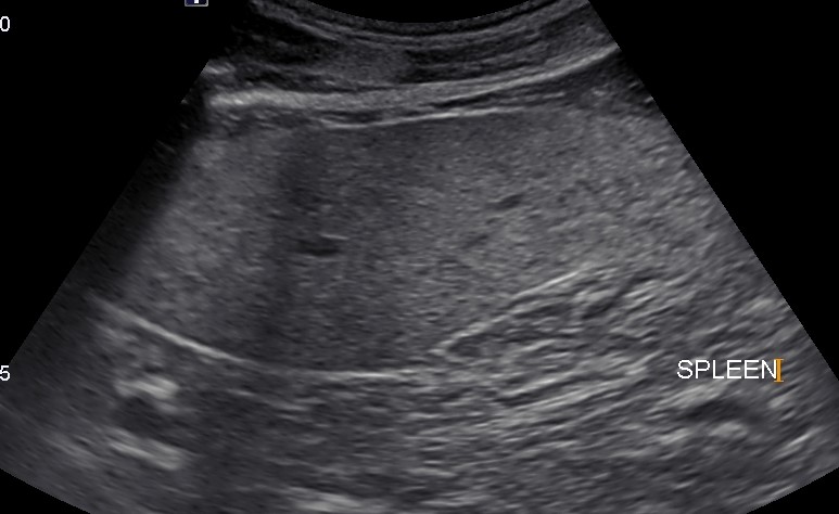 Normal Spleen