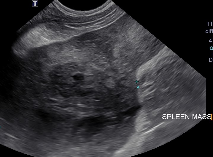 Splenic Mass